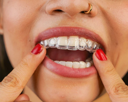 Spark Clear Aligners
