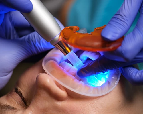 What is Cosmetic Dental Bonding?