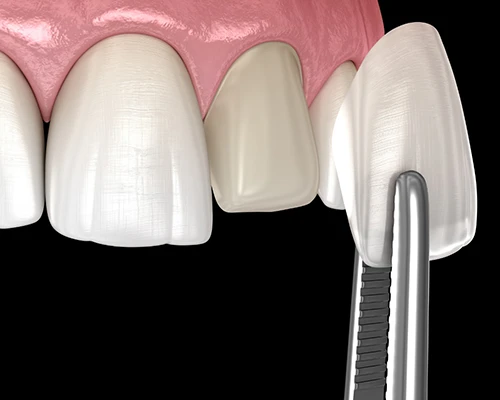 Veneers