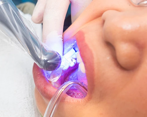 Cosmetic Dental Bonding