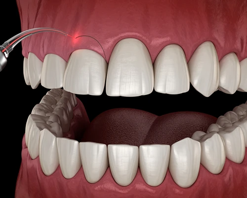 Gum Recontouring