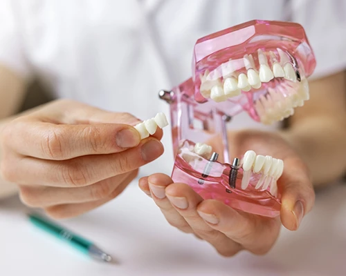 Types of Dental Bridges