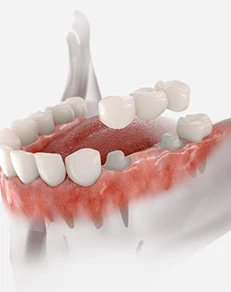 Traditional Dental Bridge