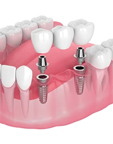 Implant Bridge