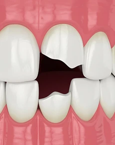 Factors That Affect the Cost of Dental Crowns
