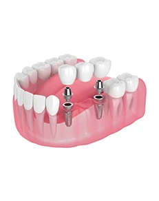 Missing Multiple Teeth