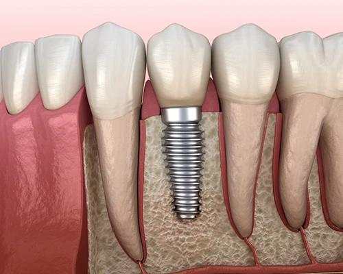 The 4-Step Dental Implant Process