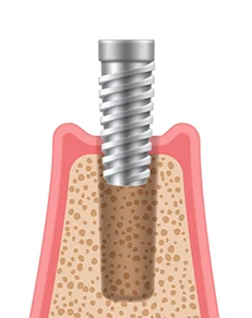 Dental Implant Surgery