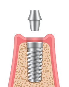 Dental Implant Osseointegration/Abutment