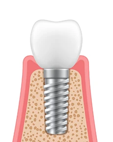 Delivery of Dental Implant Restorations