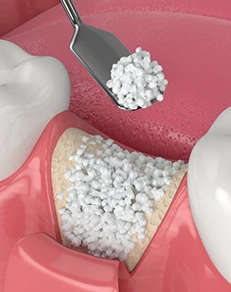 Preliminary Treatments & Dental Implant Surgery