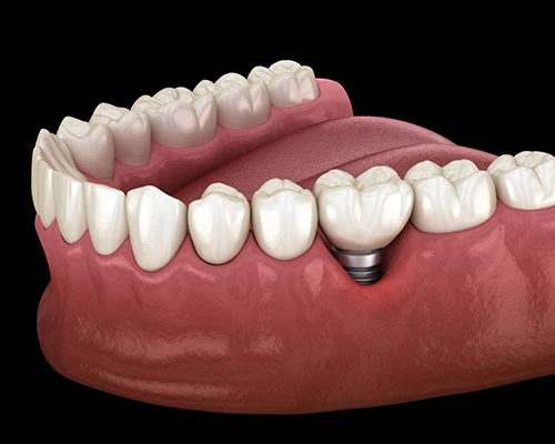 Dental Implant Failure & Salvage