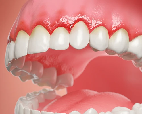 What is Gum Disease?
