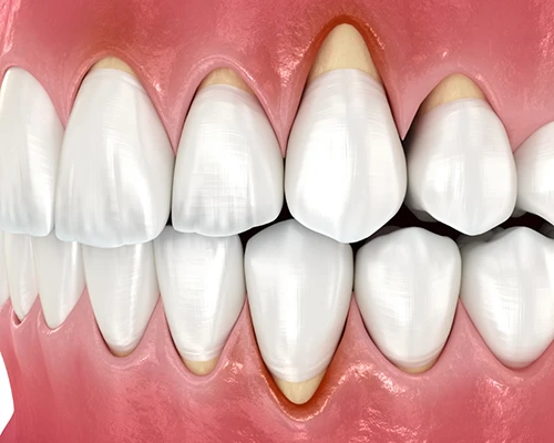 Symptoms of Gum Disease
