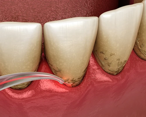 Laser Gum Disease Treatment