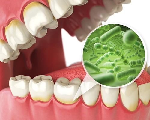 Why Do Dental Implants Fail?