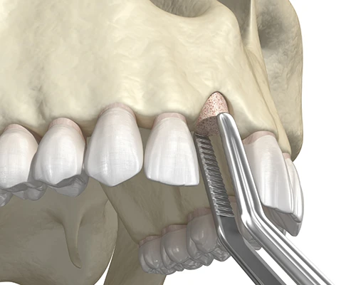 How Dental Implant Salvage Works
