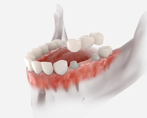 Dental Bridges