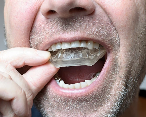 Nightguards for Teeth Grinding