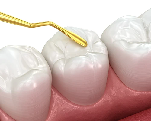 Tooth-Colored Fillings