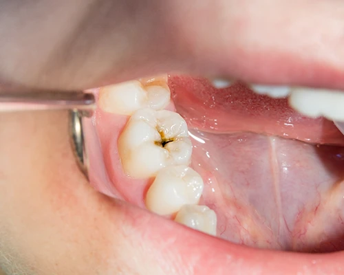 Do I Need a Root Canal?