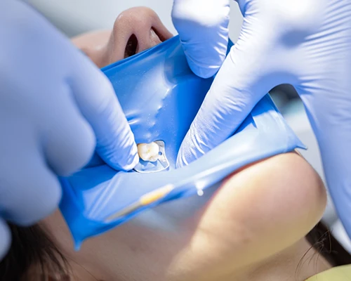 The Root Canal Process