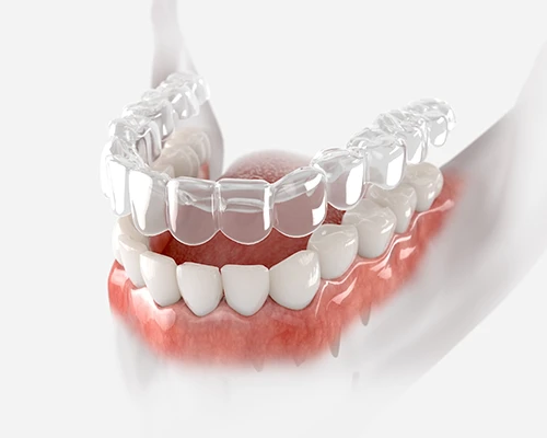 How SureSmile Works