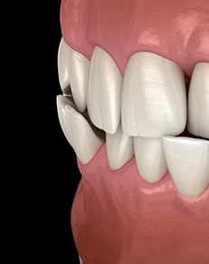 Crowded Teeth