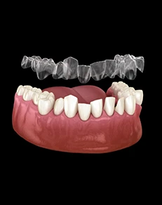 Gaps Between Teeth