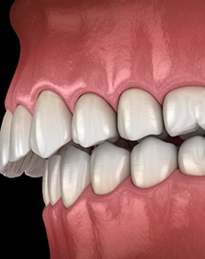 Overbite
