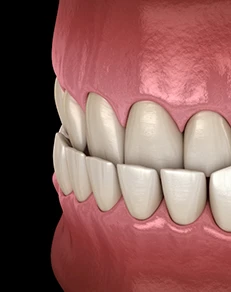 Underbite