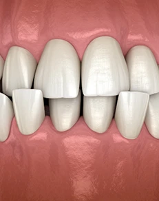Crossbite