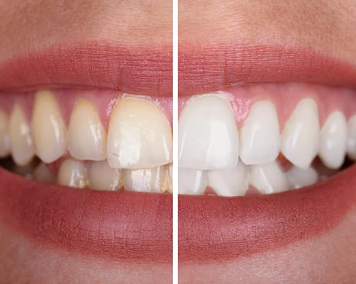 Who is a Good Candidate for Teeth Whitening?