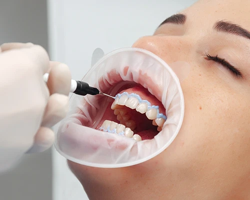 How Does Professional Take-Home Teeth Whitening Work?