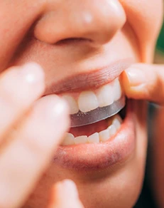 Inexpensive Teeth Whitening vs. Professional Teeth Whitening