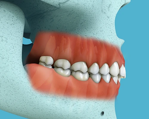 Equilibration/Occlusal Adjustments