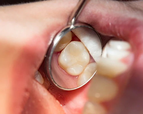 What are Tooth-Colored Fillings?