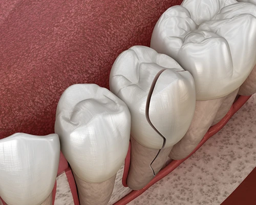 Reasons Why Tooth Extractions are Necessary