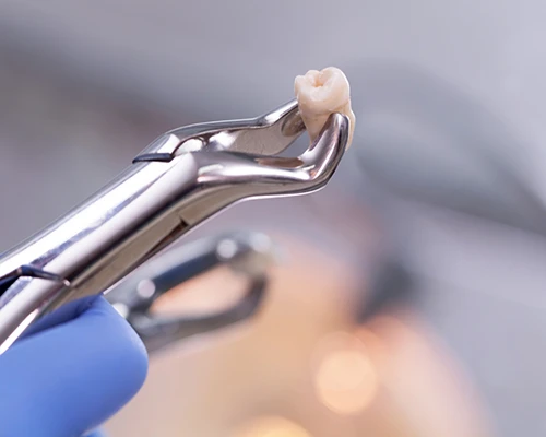 The Process of Removing a Tooth