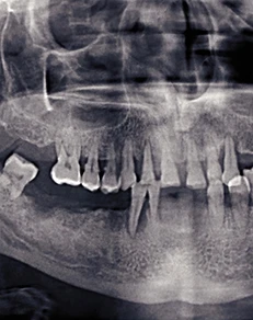 Factors That Can Affect Tooth Extraction Cost