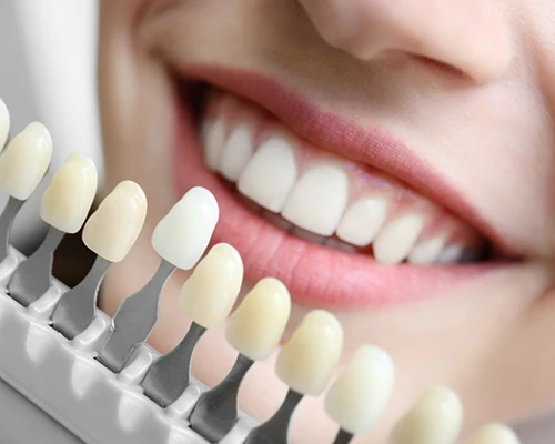 The Process of Getting Veneers